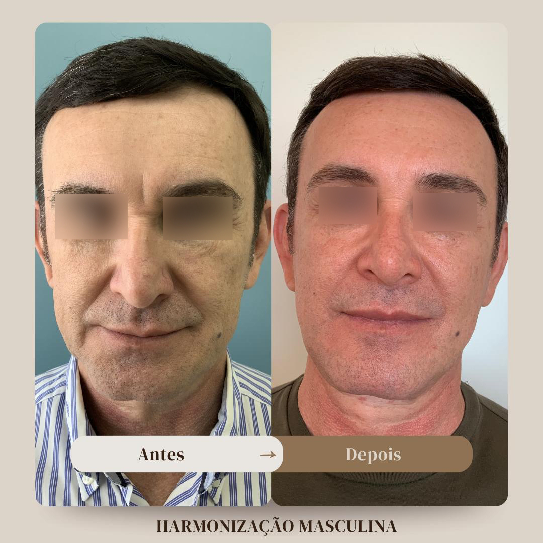Antes e depois