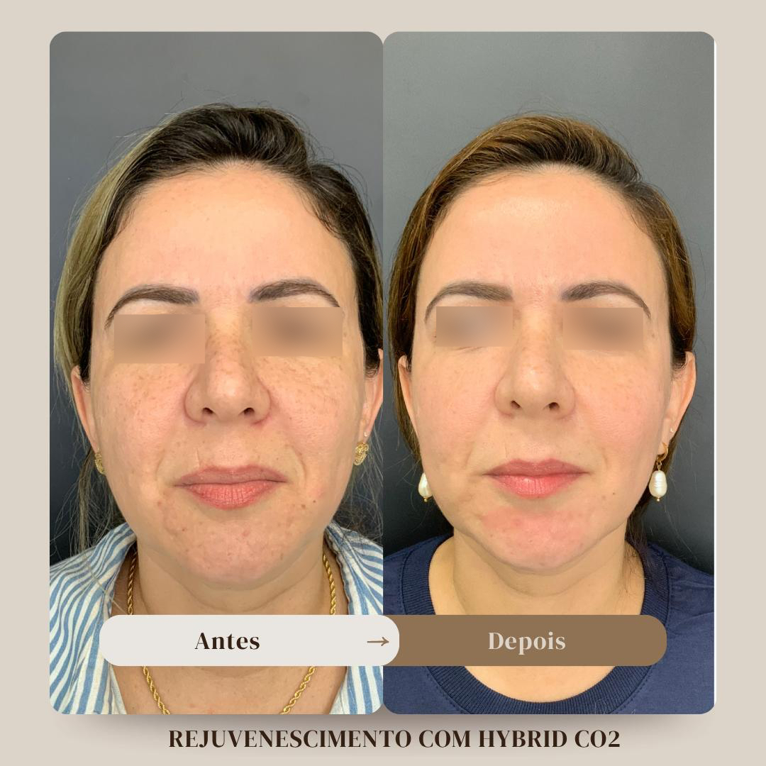 Antes e depois