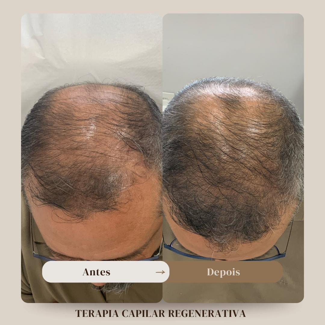 Antes e depois