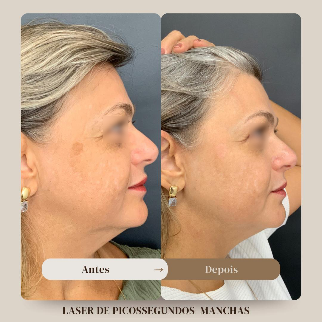 Antes e depois