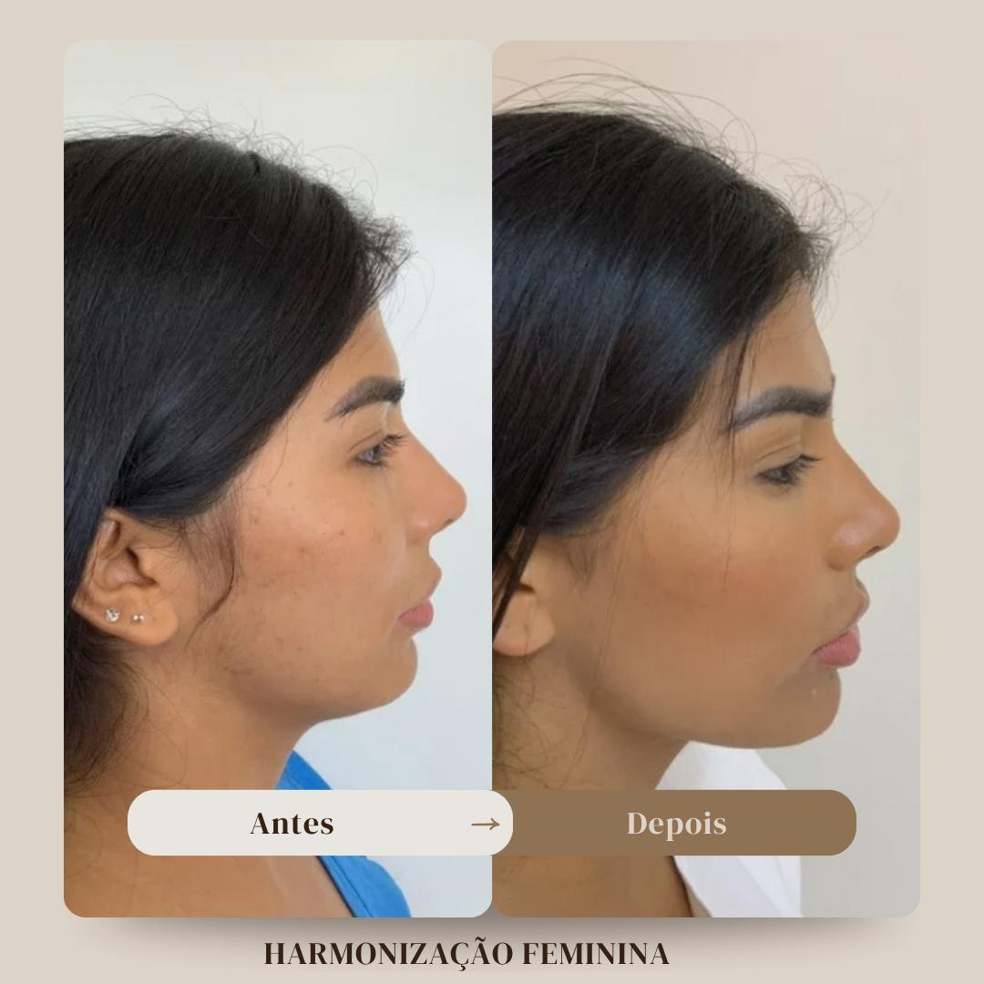 Antes e depois