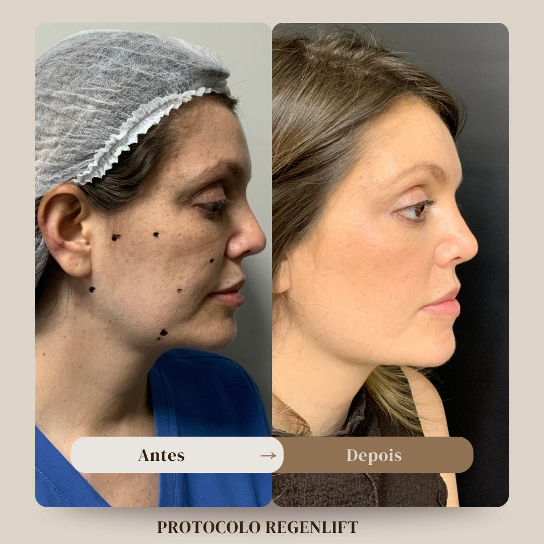 Antes e depois