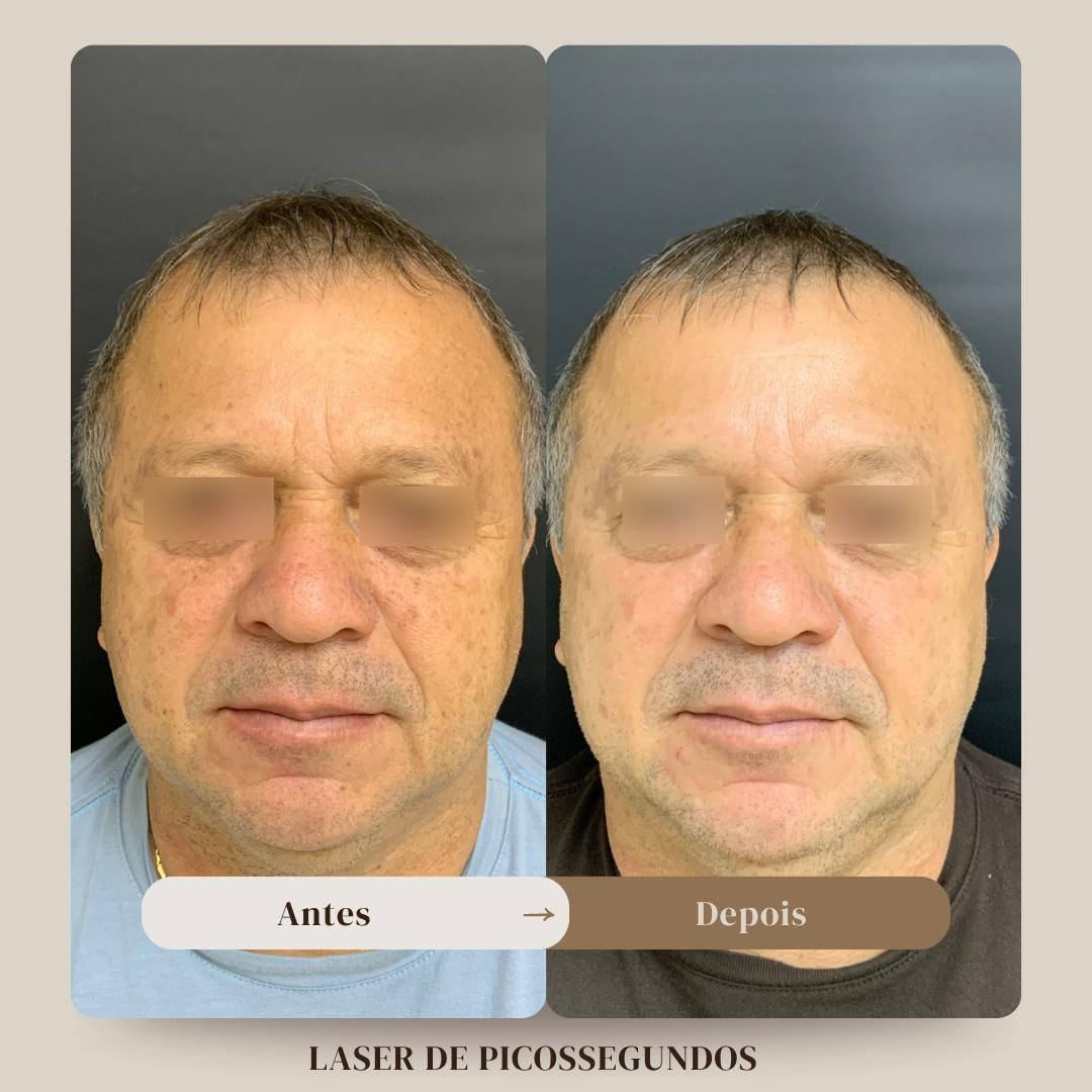 Antes e depois