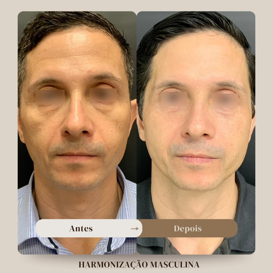 Antes e depois