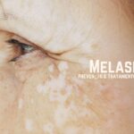 Entendendo Melasma: Prevenção e Tratamentos Eficientes na Clínica Dermatológica FR Franceschi Raad